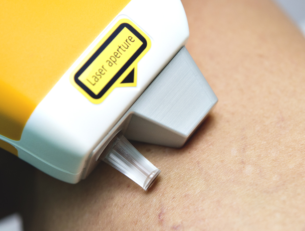 Mobile Anischt: Themenbild von Laser und Radiofrequenz