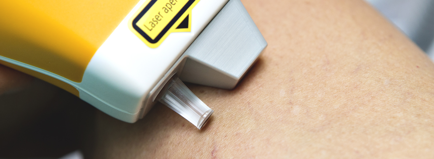 Themenbild von Laser und Radiofrequenz