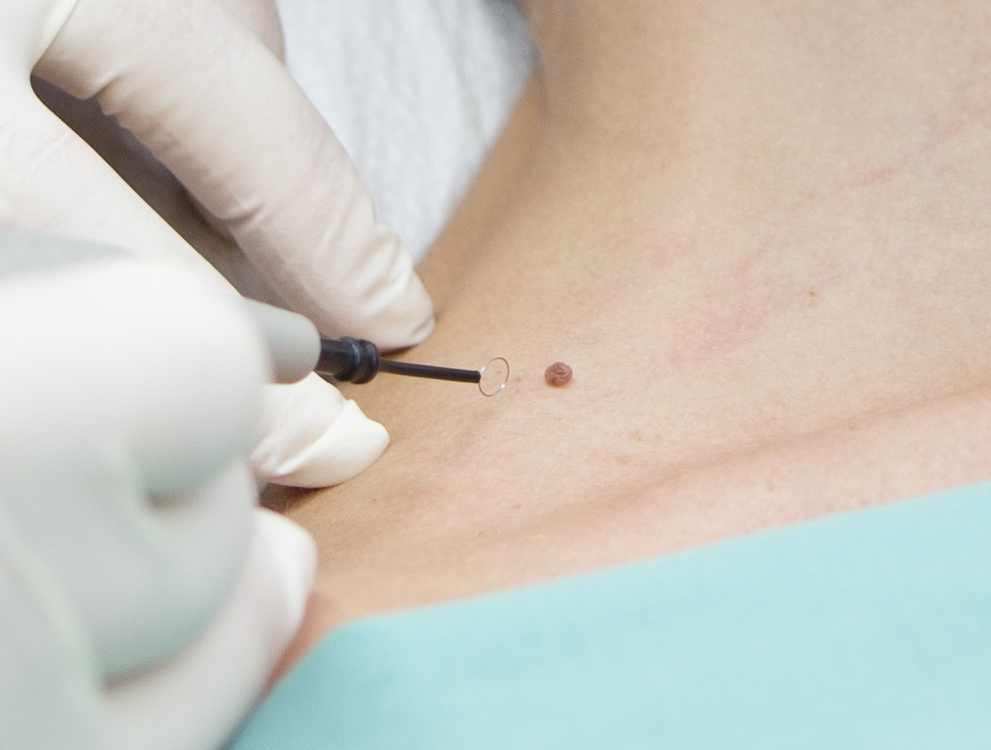 Mobile Ansicht Silderbild: Laser und Radiofrequenz