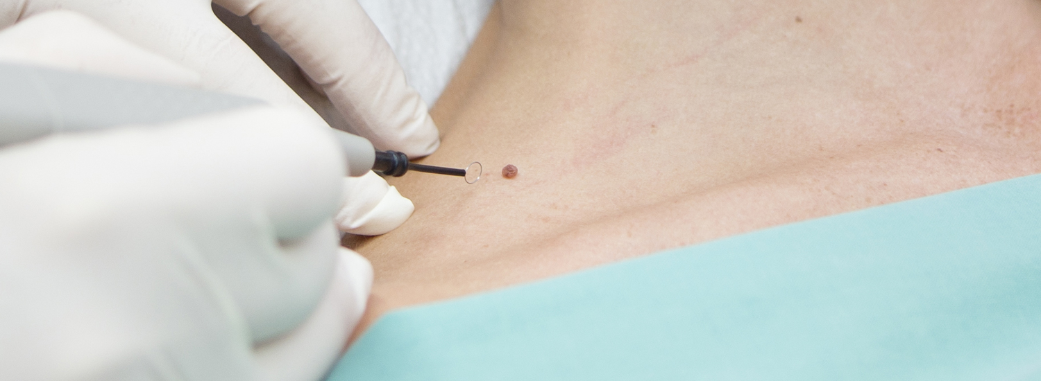 Silderbild: Laser und Radiofrequenz