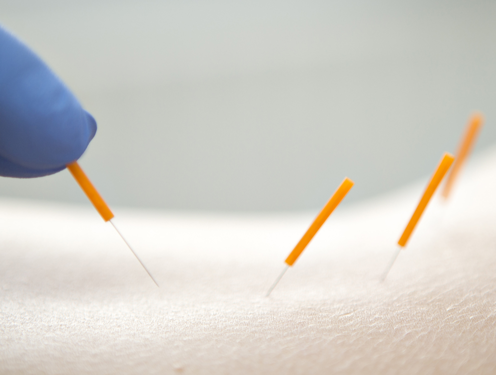 Mobile Ansicht, Silderbild: Akupunktur